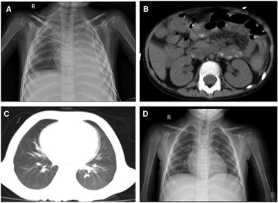 Case Report: A rare infection of multidrug-resistant Aeromonas caviae in a pediatric case with acute lymphoblastic leukemia and review of the literature